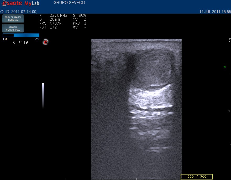 skin ultrasound plantar venous  thrombosis.1