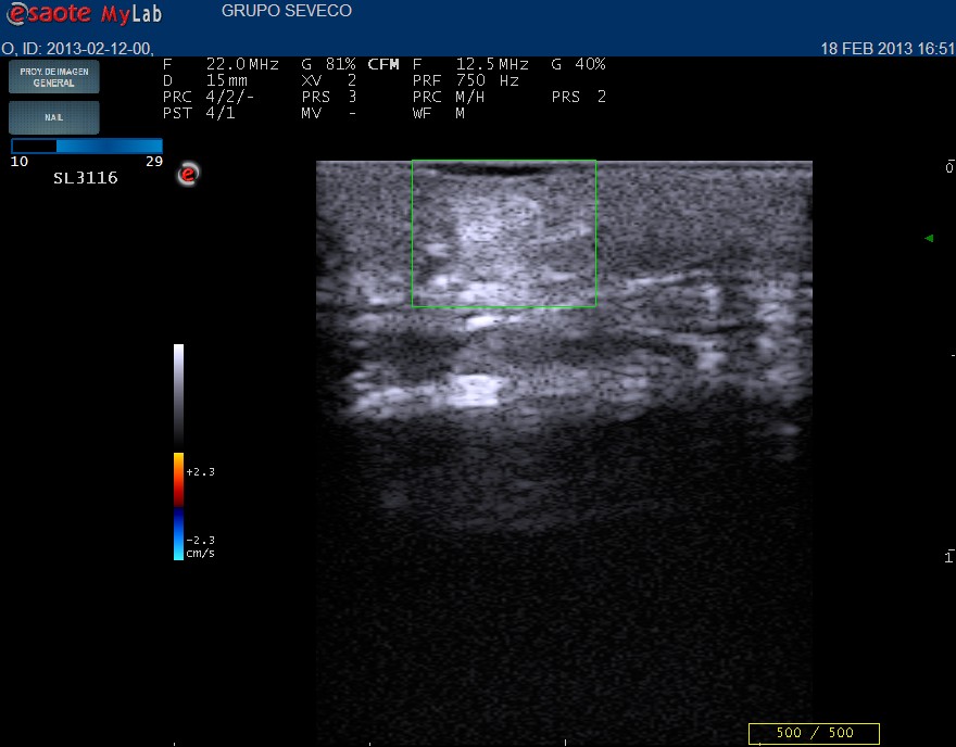skin ultrasound of striae