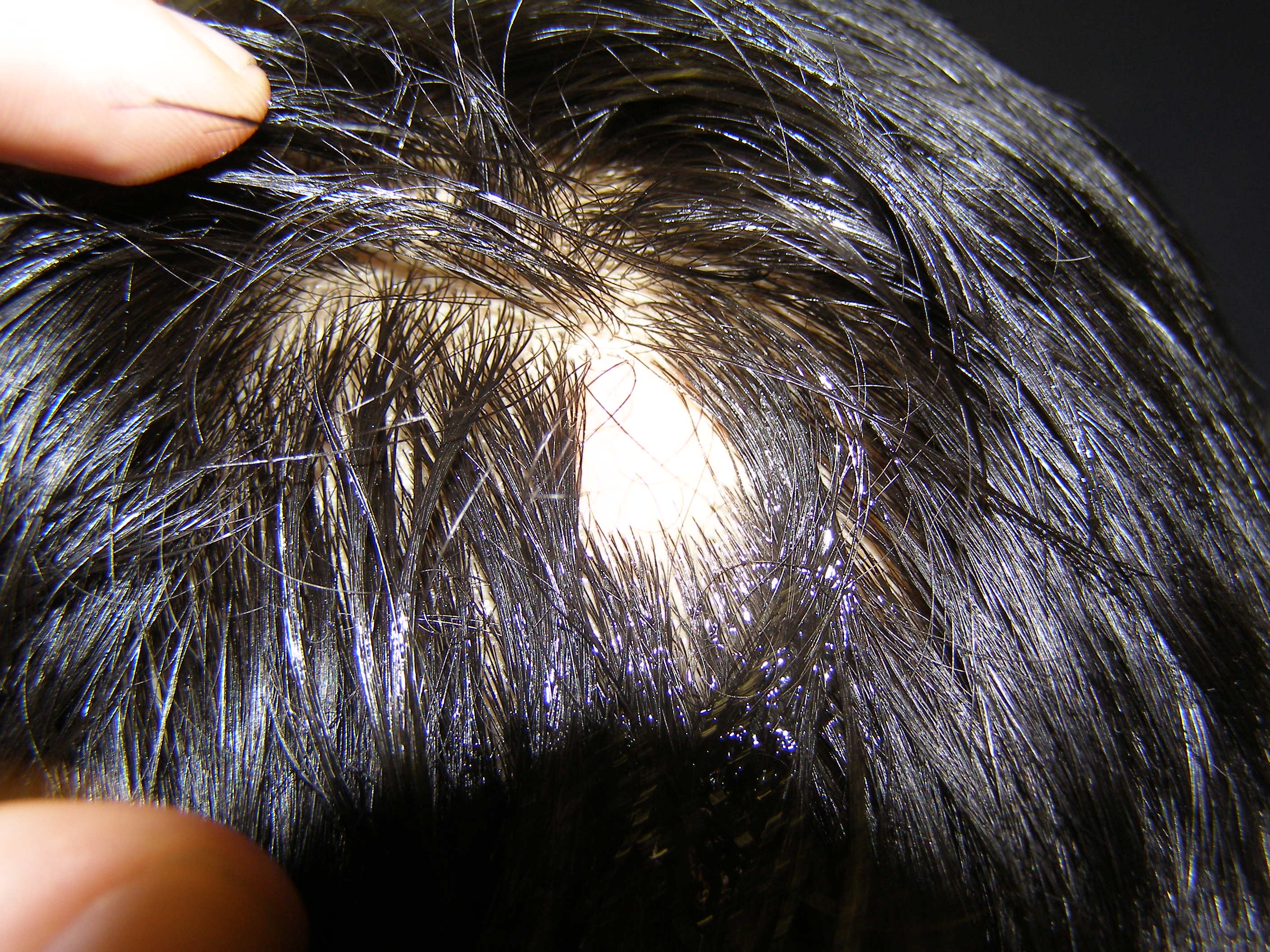 alopecia areata clinica