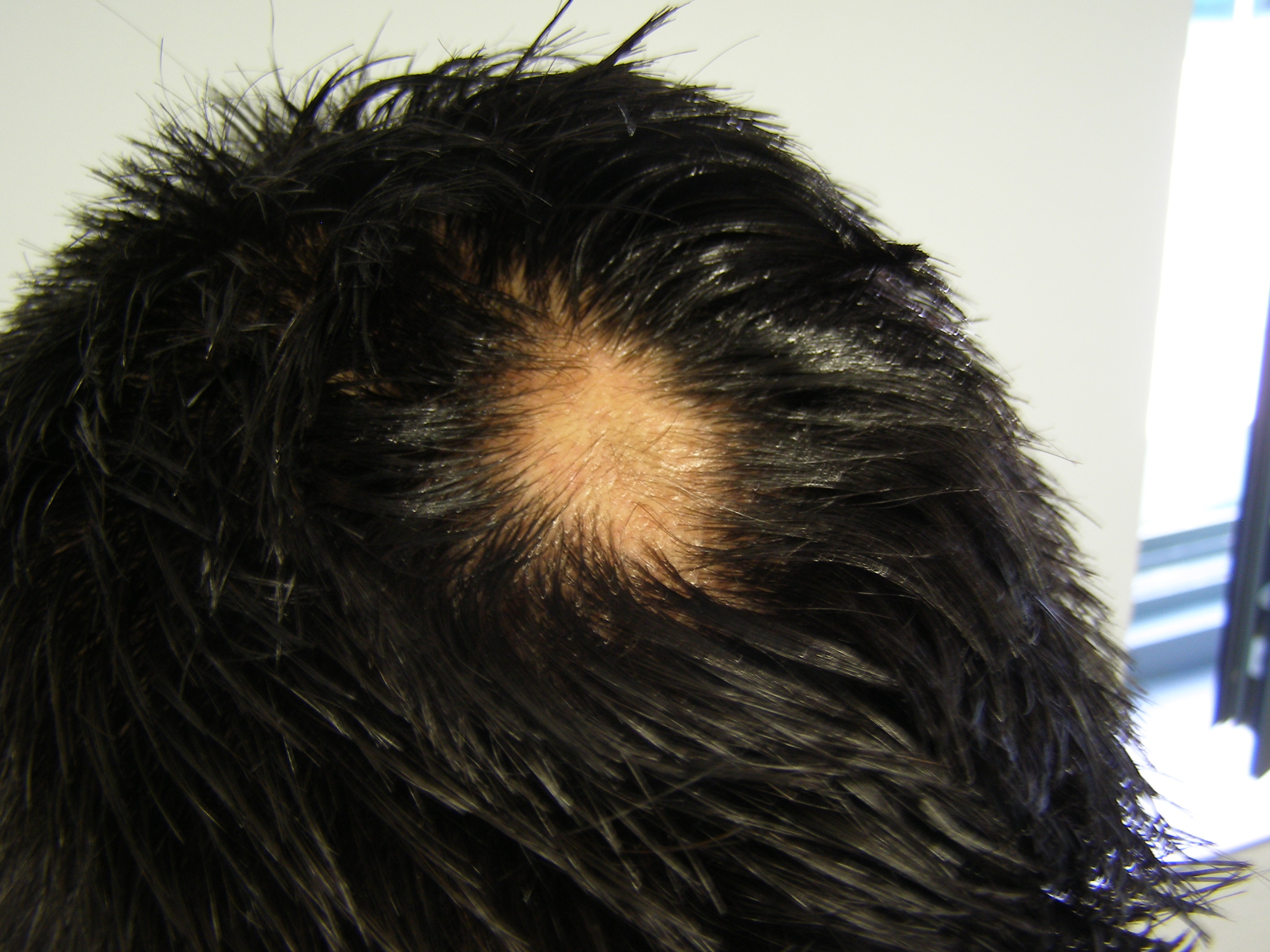 alopecia areata repoblacion